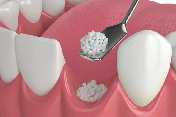 dental bone grafting