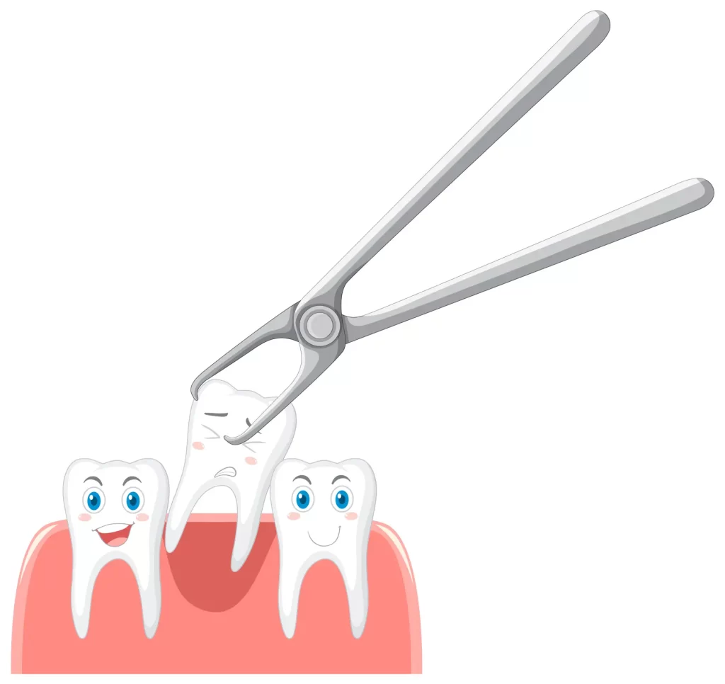 Tooth Extraction | Northridge