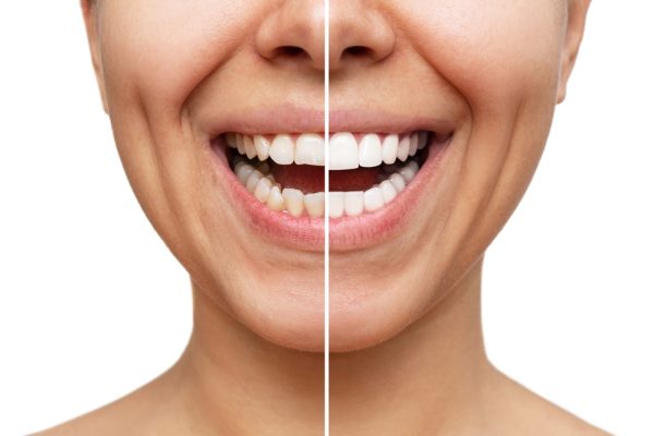 before and after teeth whitening