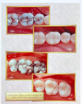 Before and after dental treatment with Dr. Gropp in Northridge