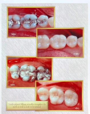 Before and after dental treatment with Dr. Gropp in Northridge