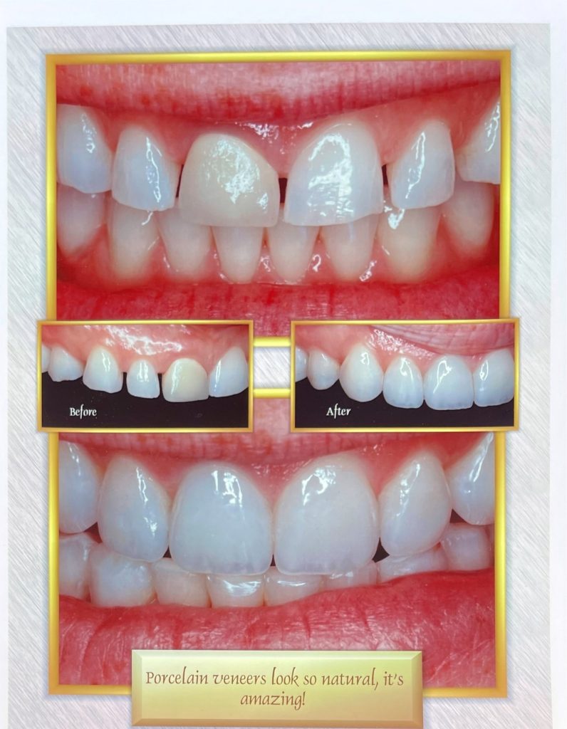 Before and after dental treatment with Dr. Gropp in Northridge