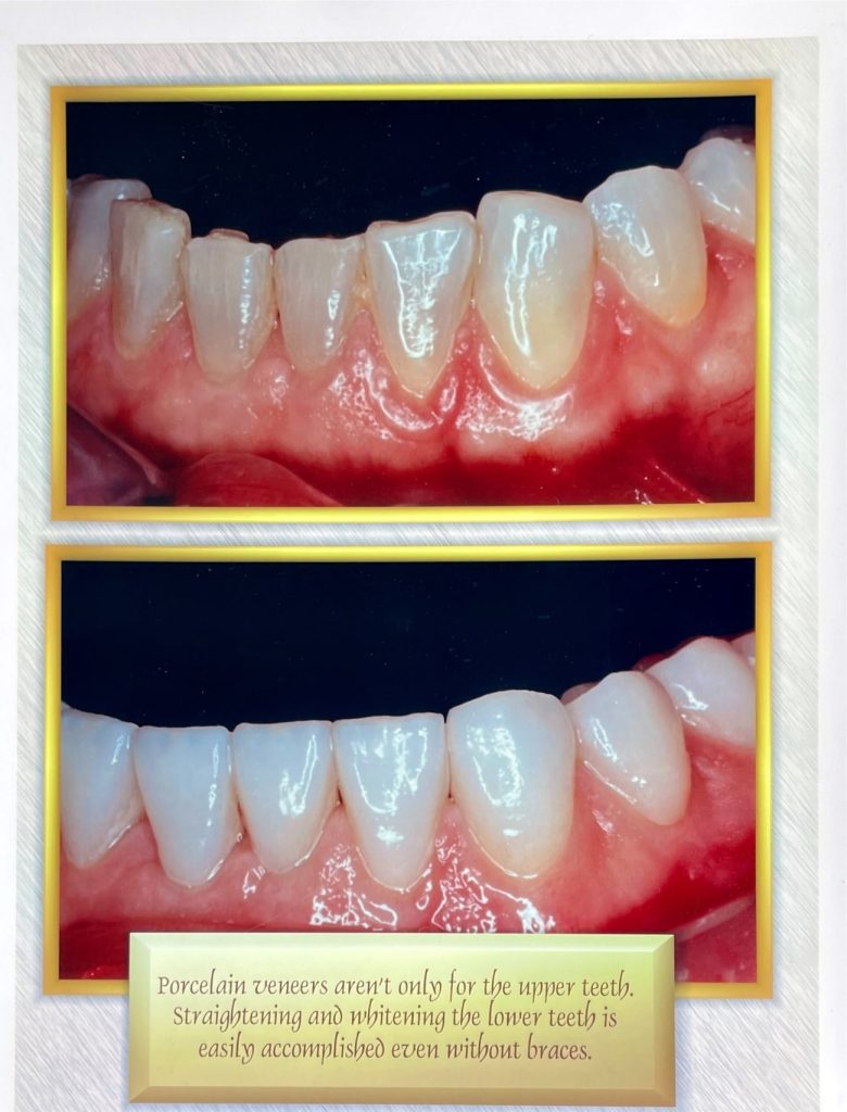 Before and after dental treatment with Dr. Gropp in Northridge