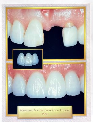 Before and after dental treatment with Dr. Gropp - Northridge dental office