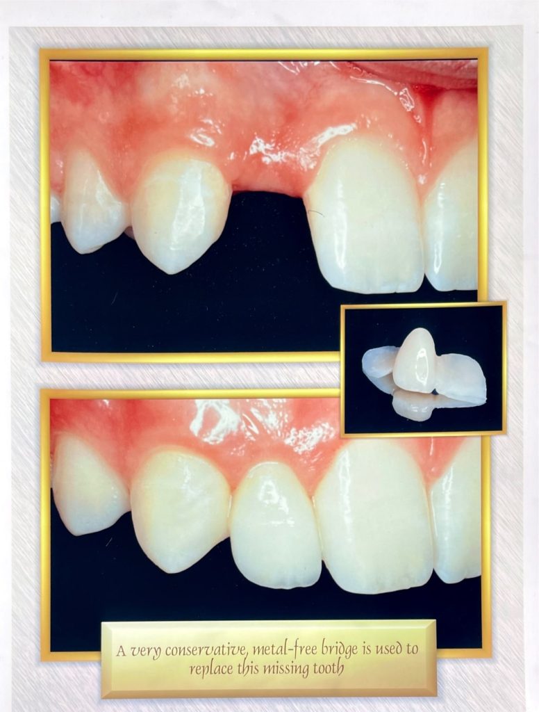 Before and after dental treatment with Dr. Gropp in Northridge